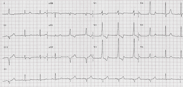 Eletrocardiograma